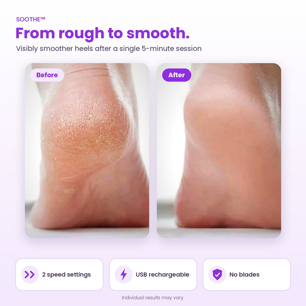 Electric Callus Remover - Soothe™